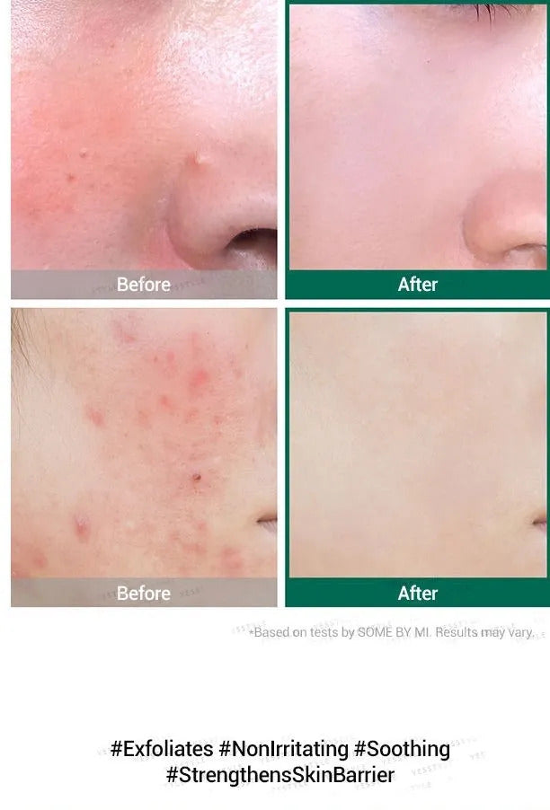 AHA BHA PHA 30 Days Miracle Serum (50 ml)